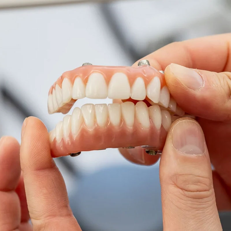 Full arch dental implants
