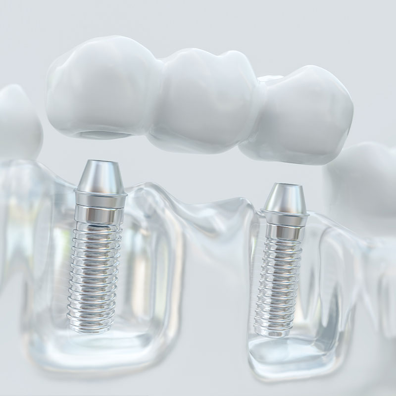 Implant-supported dental bridge