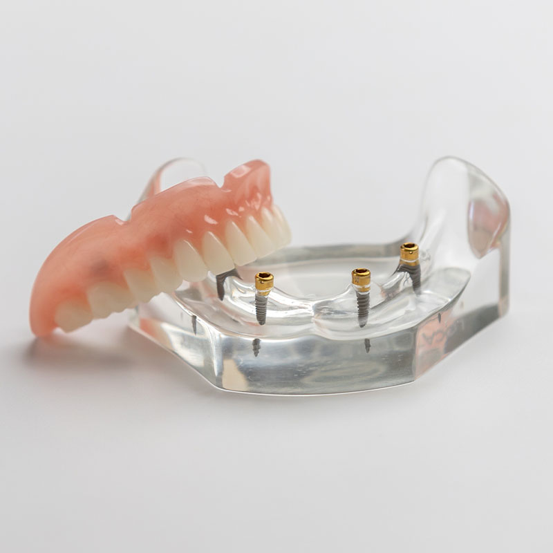 Implant-supported dentures