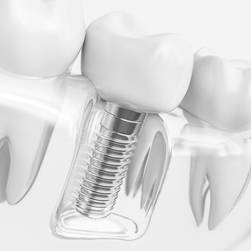 Single tooth dental implant